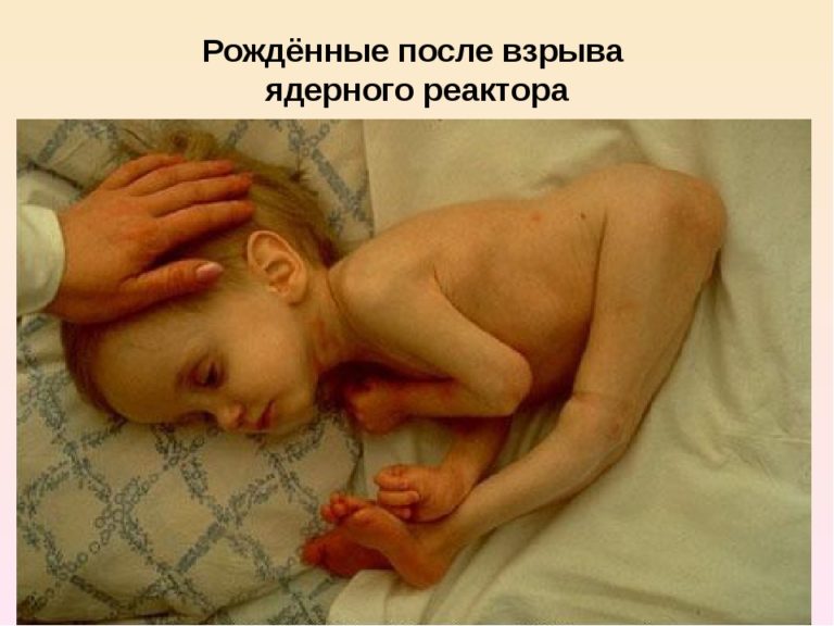 Дети Рожденные После Чернобыльской Аварии Статус